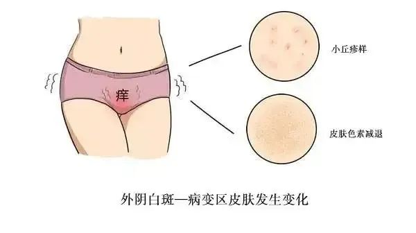 外阴白斑治愈的标准